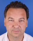 After Hair Transplant &nbsp;Temporal Hairline